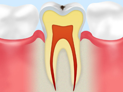C0【ごく初期段階の虫歯】