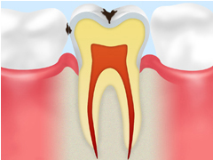 C1【エナメル質の虫歯】