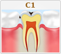 C1【エナメル質の虫歯】