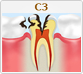 C3【神経まで達した虫歯】