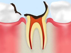 C4【歯の大部分が溶けてしまった虫歯】
