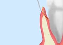 歯周ポケット掻爬（そうは）